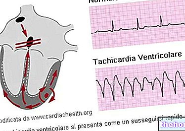 Takikardia ventrikel