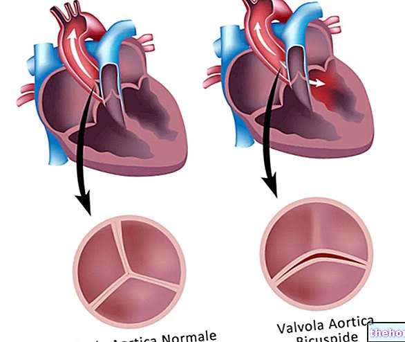 Dvigubas aortos vožtuvas: kas tai yra, simptomai ir gydymas