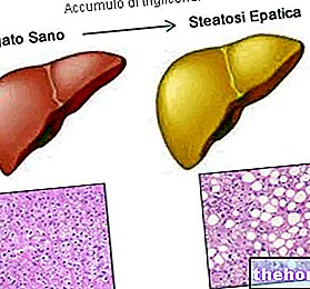 Диета и мастни чернодробни заболявания - мастен черен дроб