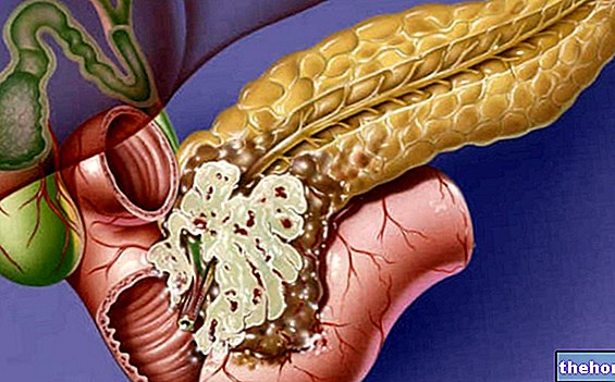 Síntomas Tumores del páncreas