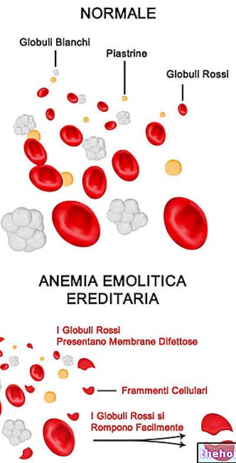 Hemolyyttinen anemia