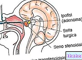 Pituitari Adenoma - Diagnosis dan Terapi