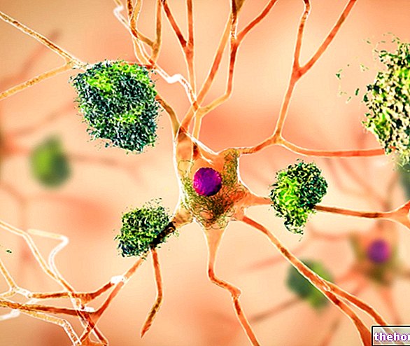 Alzheimer - Morfologi, patogenese, neurokemiske aspekter