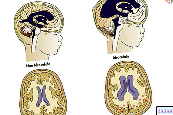 Hidrocefalija: diagnozė ir gydymas