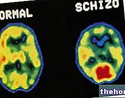 Schizophrénie : Gènes impliqués et altérations au niveau du système nerveux central