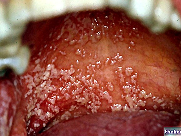 Candidiasis - former for candidiasis