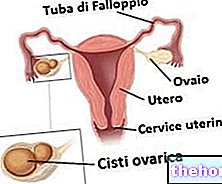 Ovariální cysta - ovariální cysta