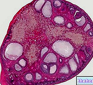 Corpus Luteum Hemorrhagic