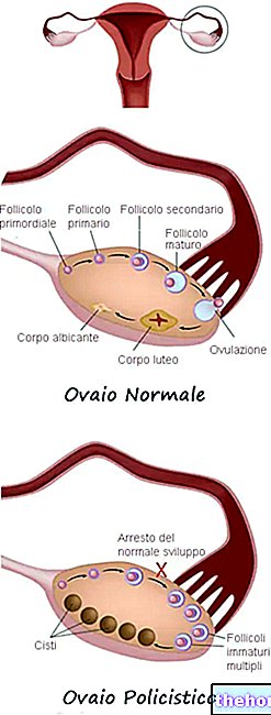Sindrome de Ovario poliquistico