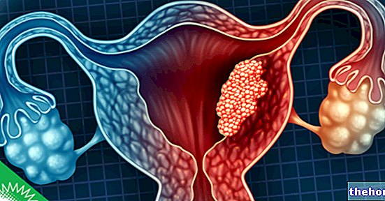 Cancer de l'endomètre : stadification et pronostic