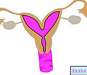 Uterus Bicorne