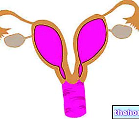 Uterus Didelfo - Double uterus