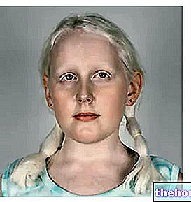 Albinismi