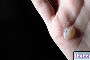Lizdinės plokštelės ant odos - odos pūslės