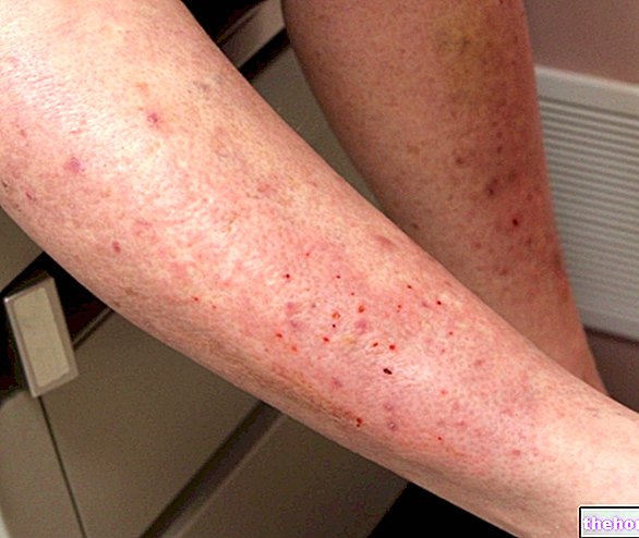 Herpetiformni dermatitis: Duhringov dermatitis