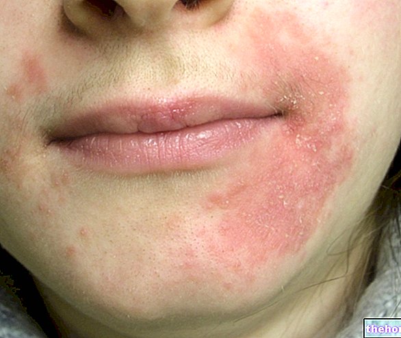 Perioral Dermatitis: What is it? Causes, Symptoms and Treatment