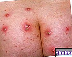 Méhsejt - Anthrax: S. Aureus bőrelváltozások