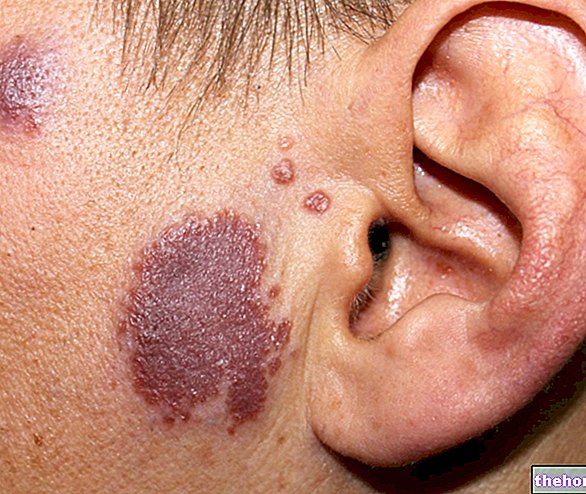 Lupus Pernio (kožní sarkoidóza): Co to je? Zkoušky a terapie