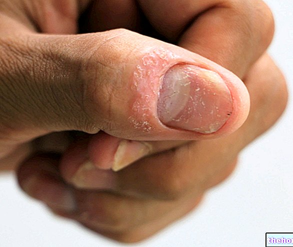 Псориазис на ноктите - Псориазис на ноктите