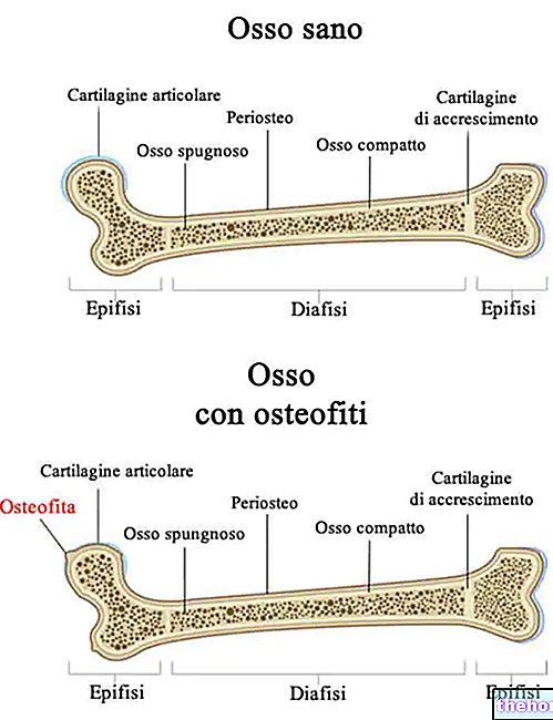 Ostéophytose