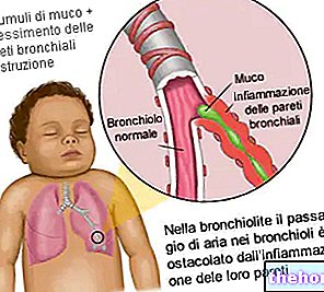 Bronhiolitis