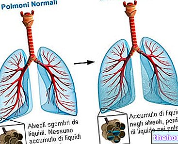здравето на дихателните пътища - Белодробен оток