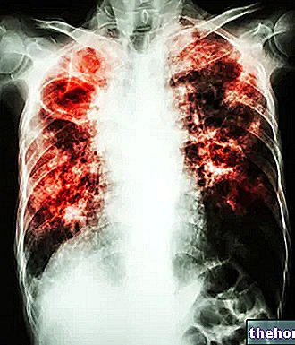 Fibrose pulmonaire idiopatique