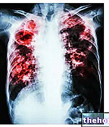 Intersticijska bolezen - pljučna intersticijska bolezen