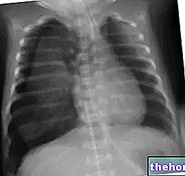 Pneumothorax spontané