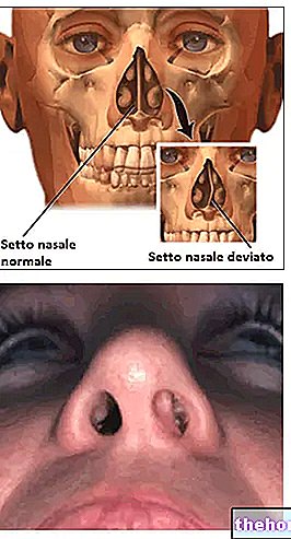 Cloison nasale déviée