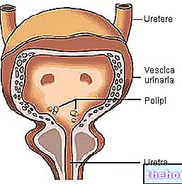 Šlapimo pūslės polipai - polipai šlapimo pūslėje