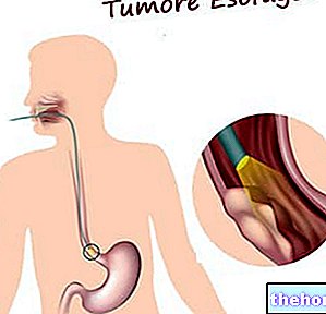 Тумор на хранопровода