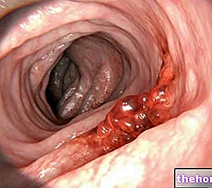 Tumeurs du côlon - rectum