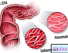 Maladies inflammatoires de l'intestin