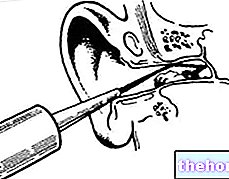 Чистка вух
