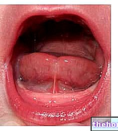 Trumpas liežuvio frenulumas: gydymas ir komplikacijos