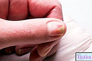 Onycholyse (détachement de l'ongle) : causes, symptômes et traitement
