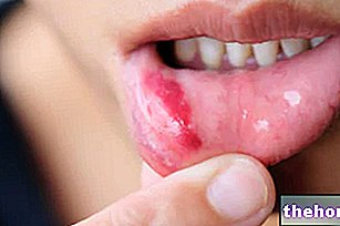 口内炎：定義、原因および症状