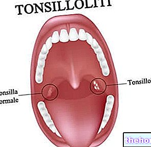 Tonsilloliidid - mandlite kivid
