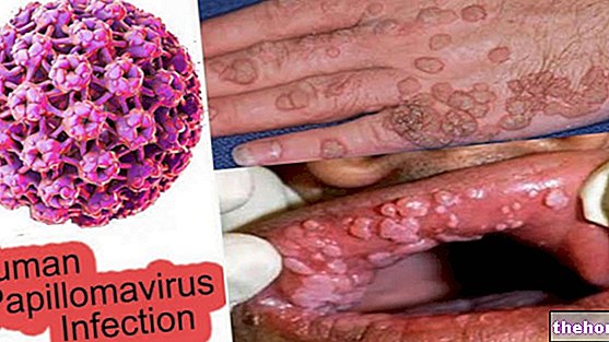 Symptômes du VPH - Virus du papillome humain