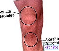 Бурсит на коляното