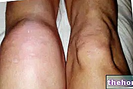 Voda v kolene - výpotok z kolena