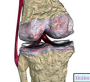 Остеоартритис колена