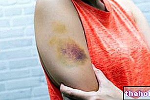 Bruise: Čo je to? Prečo sa to prejavuje? Súvisiace poruchy a liečba
