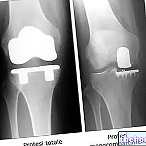 Kolenná protéza - Obnova po operácii, riziká a výhody