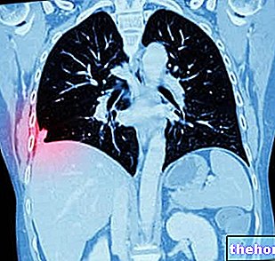 Keuhkojen adenokarsinooma