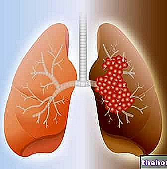Mazo šūnu plaušu vēzis