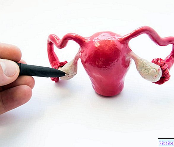 Karsinoma ovari: Sebab, Gejala dan Rawatan
