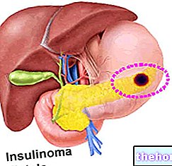 Insulinooma