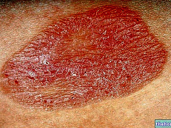 Mycosis fungoides และSèzary syndrome